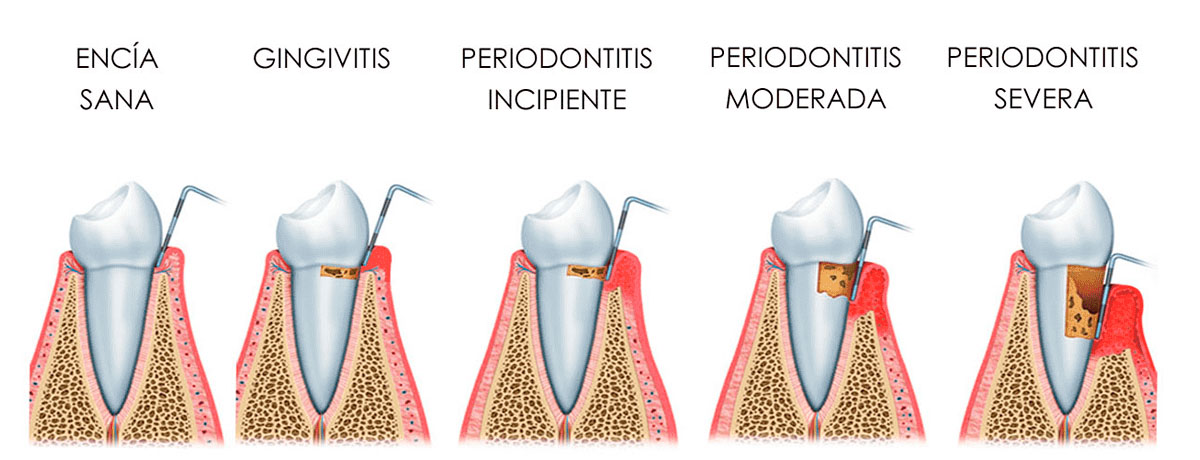 Etapas de la gingititis y la periodontitis