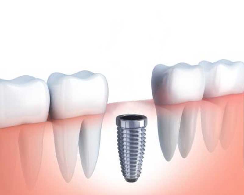 Proceso de implante dental. Dental Carpe, tu dentista en Alcoy