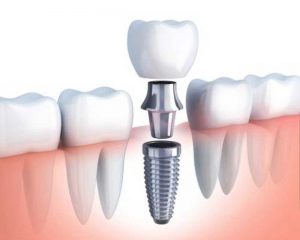 Proceso de implante dental. Dental Carpe, tu dentista en Alcoy